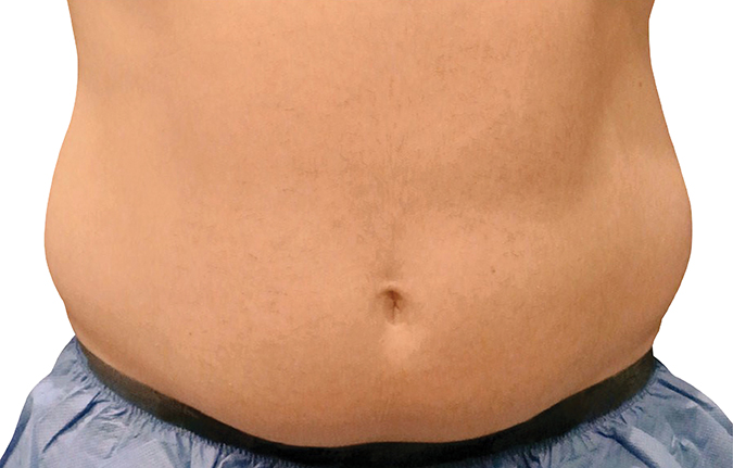 CoolSculpting® How it Works